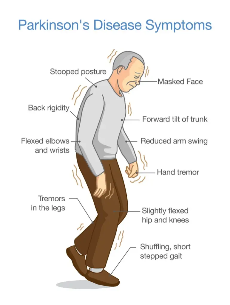 Parkinson's disease is a chronic and progressive neurological disorder that affects a person's ability to move and control their movements. It is caused by the degeneration of dopaminergic neurons in the brain, which leads to a deficiency in the neurotransmitter dopamine. This deficiency results in the characteristic motor symptoms of Parkinson's disease, including tremors, rigidity, bradykinesia (slowness of movement), and postural instability.