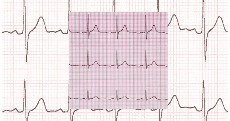 A Guide to Normal Sinus Rhythm for Nurses